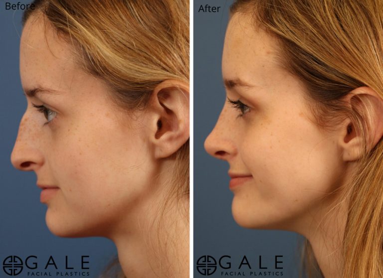SMAS Facelift Results: A Look at Before and After Comparisons