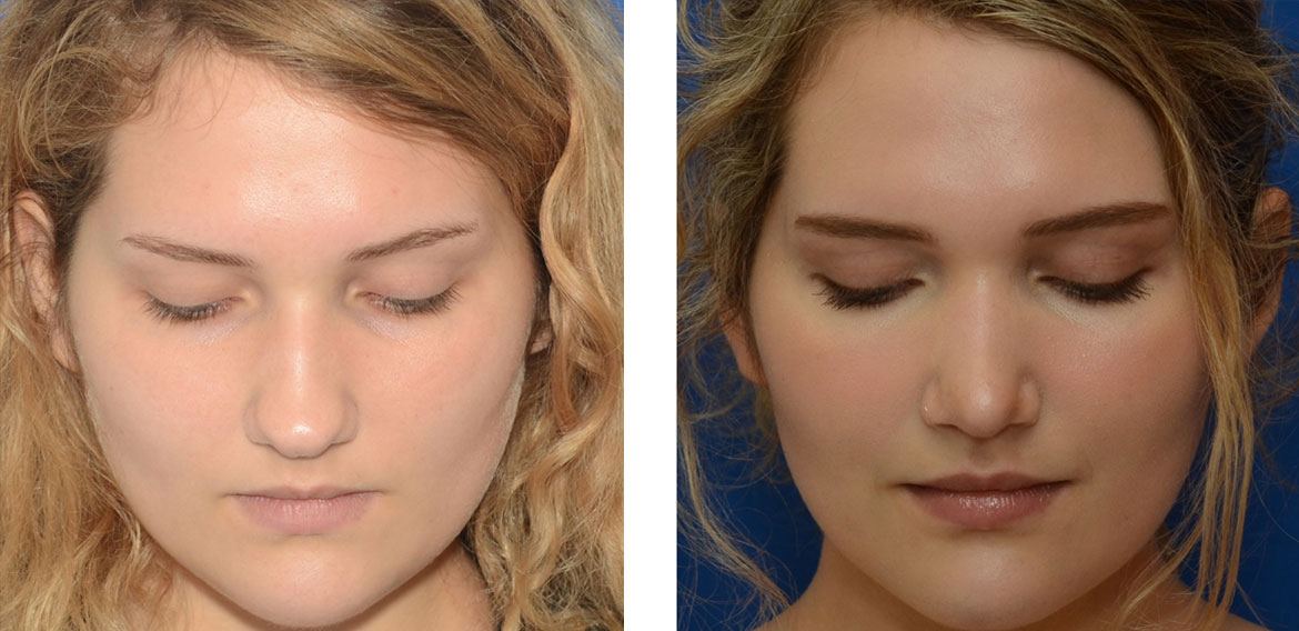 Top Rhinoplasty Surgeons in Washington DC: A Comprehensive Guide